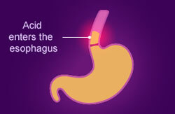 Digestion leading to heartburn